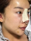 Operation: Nose — Korea cost, reviews & before-after | MISOODA