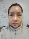 Operation : facial contouring (malar, chin, square jaw), nose — Korea cost, reviews & before-after | MISOODA