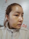 Operation : facial contouring (malar, chin, square jaw), nose — Korea cost, reviews & before-after | MISOODA
