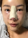 Operation: Nose — Korea cost, reviews & before-after | MISOODA