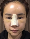 Operation: Nose — Korea cost, reviews & before-after | MISOODA