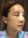 Operation: Nose — Korea cost, reviews & before-after | MISOODA