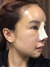 Operation: Nose — Korea cost, reviews & before-after | MISOODA