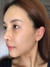 Operation: Nose — Korea cost, reviews & before-after | MISOODA