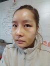 Operation : facial contouring (malar, chin, square jaw), nose — Korea cost, reviews & before-after | MISOODA