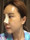 Operation: Nose — Korea cost, reviews & before-after | MISOODA