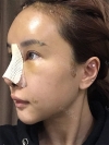 Operation: Nose — Korea cost, reviews & before-after | MISOODA
