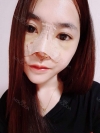 Non-Silicone Implant Nose Surgery (ribs -> rib cartilage), mandibular implants — Korea cost, reviews & before-after | MISOODA