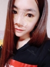 Non-Silicone Implant Nose Surgery (ribs -> rib cartilage), mandibular implants — Korea cost, reviews & before-after | MISOODA