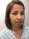 Fat Graft in full disclosure — Korea cost, reviews & before-after | MISOODA
