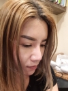 Full Face Fat Graft — Korea cost, reviews & before-after | MISOODA