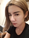 Full Face Fat Graft — Korea cost, reviews & before-after | MISOODA
