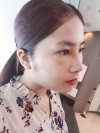 Non-Silicone Implant Nose Surgery (ribs -> rib cartilage), mandibular implants — Korea cost, reviews & before-after | MISOODA