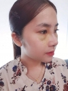 Non-Silicone Implant Nose Surgery (ribs -> rib cartilage), mandibular implants — Korea cost, reviews & before-after | MISOODA