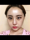 No regret with my decision! — Korea cost, reviews & before-after | MISOODA