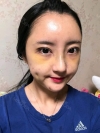 Double Eyelid + Rhinoplasty + Fat Graft — Korea cost, reviews & before-after | MISOODA