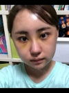 No regret with my decision! — Korea cost, reviews & before-after | MISOODA