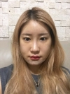 Facial Contour No regret! — Korea cost, reviews & before-after | MISOODA