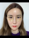 Double Eyelid + Rhinoplasty + Fat Graft + Facial Contour — Korea cost, reviews & before-after | MISOODA
