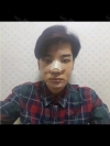 Facial contour + Rhinoplasty + Double eyelid — Korea cost, reviews & before-after | MISOODA