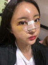Double Eyelid + Rhinoplasty + Fat Graft — Korea cost, reviews & before-after | MISOODA