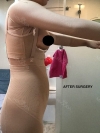 Liposuction and Breast Augmentation — Korea cost, reviews & before-after | MISOODA