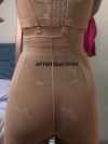 Liposuction and Breast Augmentation — Korea cost, reviews & before-after | MISOODA
