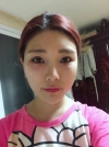Eye surgery has succeeded in the way different image — Korea cost, reviews & before-after | MISOODA
