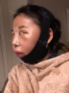 Girin: facial contouring, acculift, rhino, forehead lift, des, epi, fat graft — Korea cost, reviews & before-after | MISOODA