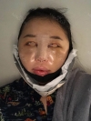 Girin: facial contouring, acculift, rhino, forehead lift, des, epi, fat graft — Korea cost, reviews & before-after | MISOODA