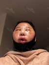 Girin: facial contouring, acculift, rhino, forehead lift, des, epi, fat graft — Korea cost, reviews & before-after | MISOODA