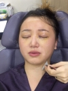 Girin: facial contouring, acculift, rhino, forehead lift, des, epi, fat graft — Korea cost, reviews & before-after | MISOODA
