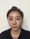 Goodbye button nose! — Korea cost, reviews & before-after | MISOODA