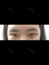 [Eyes surgery] Double eyelids plasty with incision, reoperation+upper cantho plasty+lateral cantho plasty+lower lateral cantho plasty — Korea cost, reviews & before-after | MISOODA