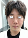 [Contouring Plastic Surgery] I believe it’s the best plastic surgery for men. — Korea cost, reviews & before-after | MISOODA
