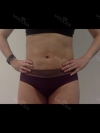 Revision Lower Body Liposuction (Hip, Thighs, Knees, Calves Botox) — Korea cost, reviews & before-after | MISOODA