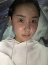 Two jaw surgery in South Korea — Korea cost, reviews & before-after | MISOODA