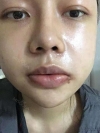 3 type of facial contour surgery — Korea cost, reviews & before-after | MISOODA