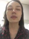 3 type of facial contour surgery — Korea cost, reviews & before-after | MISOODA