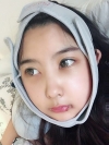 Cheekbone Reduction & V-Line Surgery — Korea cost, reviews & before-after | MISOODA