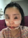 Two jaw surgery in South Korea — Korea cost, reviews & before-after | MISOODA