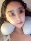 Cheekbone Reduction & V-Line Surgery — Korea cost, reviews & before-after | MISOODA