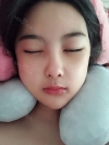 Cheekbone Reduction & V-Line Surgery — Korea cost, reviews & before-after | MISOODA
