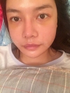 3 type of facial contour surgery — Korea cost, reviews & before-after | MISOODA