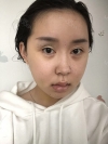 Two jaw surgery in South Korea — Korea cost, reviews & before-after | MISOODA