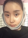 Two jaw surgery in South Korea — Korea cost, reviews & before-after | MISOODA