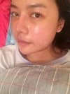 3 type of facial contour surgery — Korea cost, reviews & before-after | MISOODA