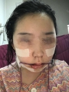 Two jaw surgery in South Korea — Korea cost, reviews & before-after | MISOODA