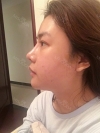 3 type of facial contour surgery — Korea cost, reviews & before-after | MISOODA