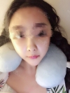 Cheekbone Reduction & V-Line Surgery — Korea cost, reviews & before-after | MISOODA